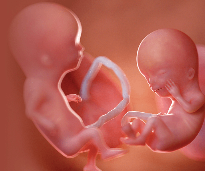 multiple pregnancy scan twin pregnancy scan delhi