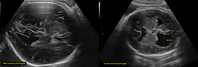 What Is Ventriculomegaly Apollo Centre For Fetal Medicine